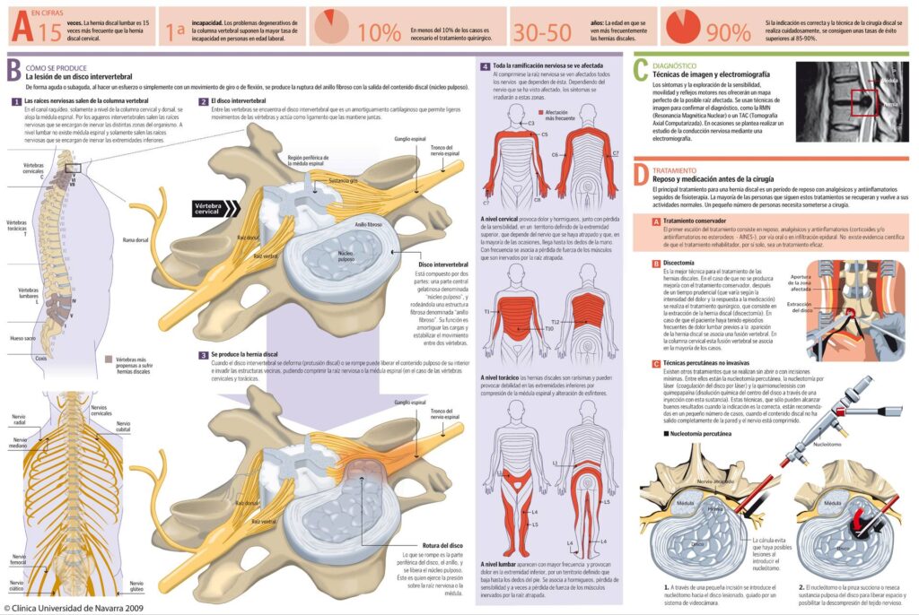 "Evolución hernia discal lumbar tratada con osteopatía para dolor de espalda"